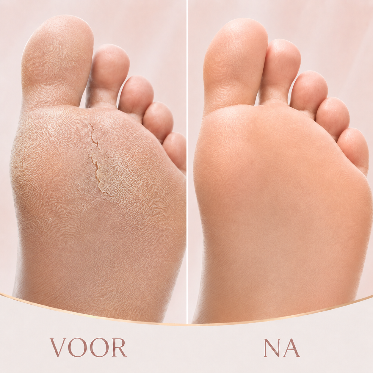 SoftStep™ Voetverzorger