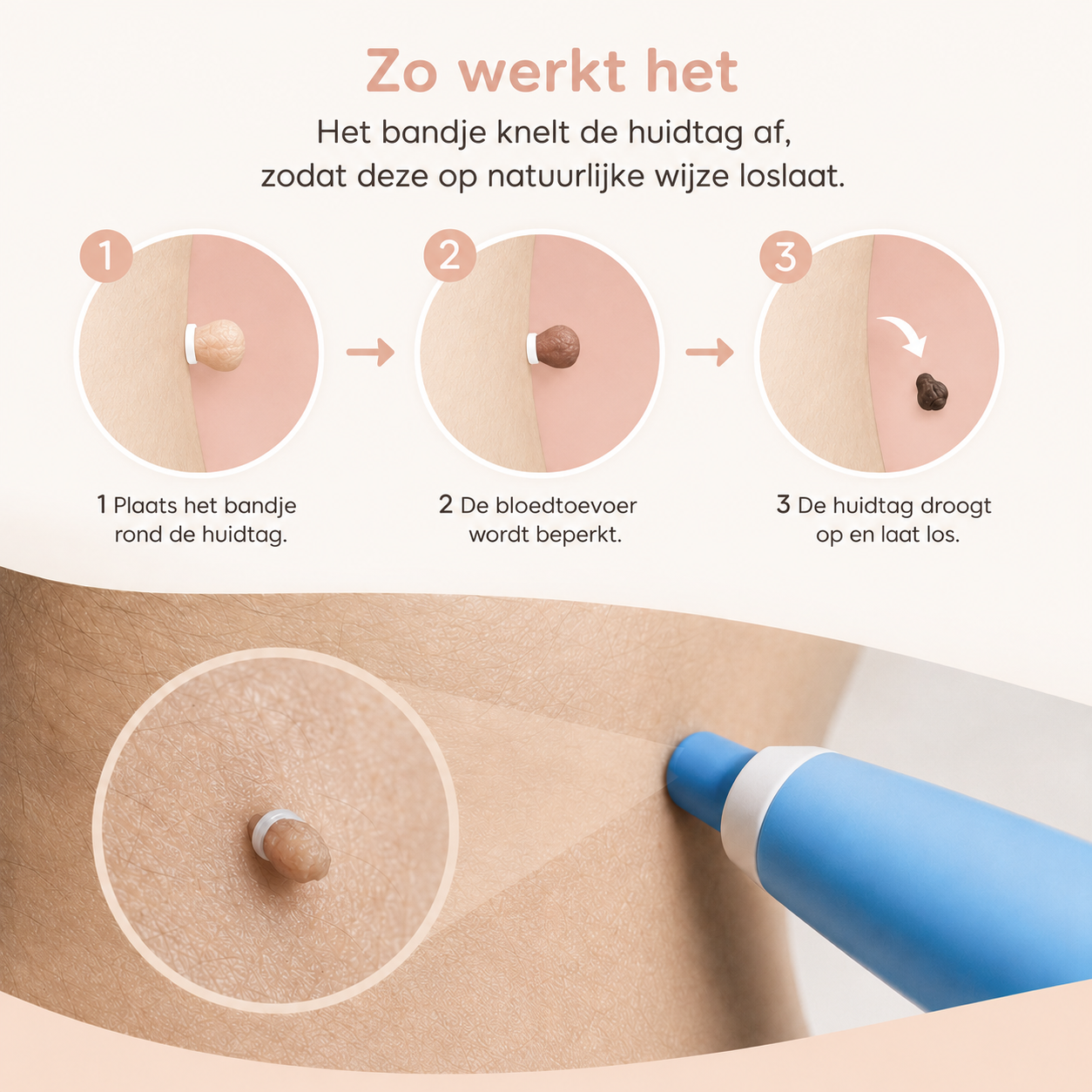 TagAway™ Huidtag Verwijderingsset — Klein voor een ander. Storend voor jou.
