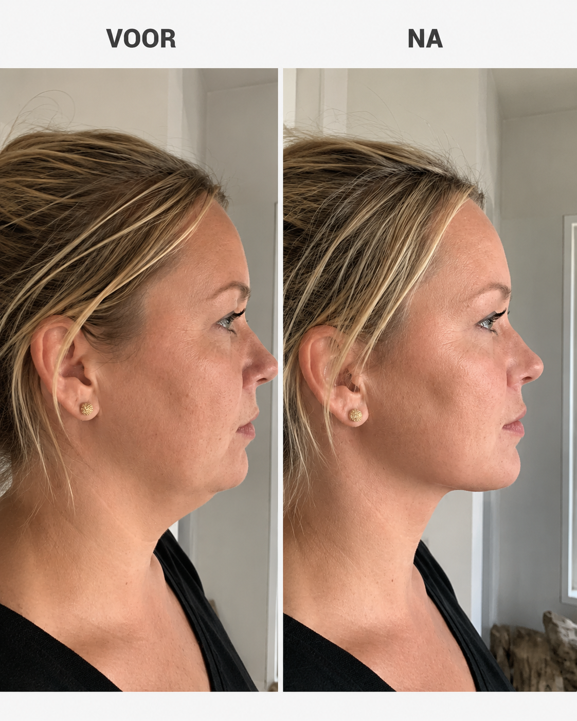 JawCore™ Kaaktrainer – Voor gerichte training van je kauwspieren.